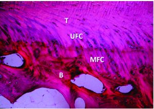 Figure 1: Organised transition from tendon (T) to demineralised fibrocartilage (UFC) to mineralized fibrocartilage (MFC) and bone (B). Courtesy: Muller et al, 2013.