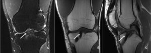 Figure 1: Magnetic resonance imaging (MRI) of a left knee of a 21-years old male patient one year after ACL reconstruction with an autologous quadriceps tendon grafts. A) Coronal T2-weighted coronal image with the arrow indicating the fibrous interface between the soft tissue graft and the bone tunnel. B) T1-weighted coronal cut with a homogenous intra-tunnel portion of the graft (arrow). C) T1-weighted sagittal image. At the distal part of the tibial bone tunnel the interference screw is visible. The arrow proximal to the interference screw highlights the fibrous interface in the anterior part of the bone tunnel.