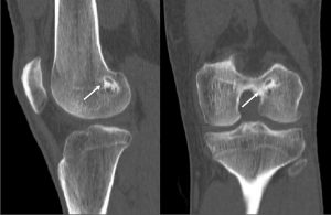 Figure 2: Sagittal and coronal computed tomography image of a left knee of a patient six months after ACL reconstruction with an aoutologous quadriceps tendon with a patellar bone block in the femoral tunnel. The bone block is partially integrated in the surrounding bone (arrow). The bone tunnel is surrounded by a thin sclerotic wall (arrow).