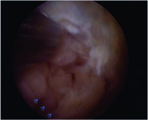 Figure 1a: Arthroscopic view of knee joint through anterolateral portal showing synovial hypertrophy (small arrows) in the suprapatellar fossa with 30 degree lens and camera facing 4 'o clock position.