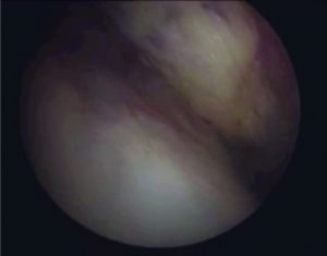 Figure 2a: Arthroscopic view of knee joint through anterolateral portalshowing reddish brown tumor with telangiectatic arterioles suggestive of hemangioma(H) in the lateral aspect of suprapatellar fossa with 30 degree lens and camera facing 12 'o clock position.