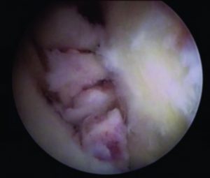 Figure 2c: Piecemeal excision (arrow heads) of the tumor done with arthroscopic scissors through the anterolateral portal with 30 degree lens and camera facing 12' o clock position.