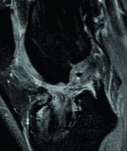 Figure 3: T2-weighted MRI of a left knee of a patients four years following ACL revision with soft tissue allograft and a bony reaction with consecutive tibial bone tunnel widening due to a fixation device. The graft in the bone tunnel is not homogenous and surrounded by irregular fibrous tissue. At the proximal part of the bone tunnel an evident synovial influx is visible.