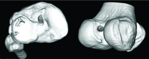 Figure 4: Three-dimensional CT image demonstrating the tibial (image on the left) and femoral (image on the right) tunnel placement in single-bundle ACL reconstruction.