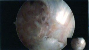 Figure 6: Arthroscopic picture of ruptured LARS stump with visible particulate debris of the LARS visible on the background of PCL