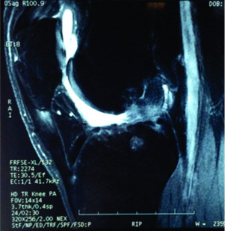 Asian Journal of Arthroscopy | Synthetic Grafts in Anterior Cruciate ...