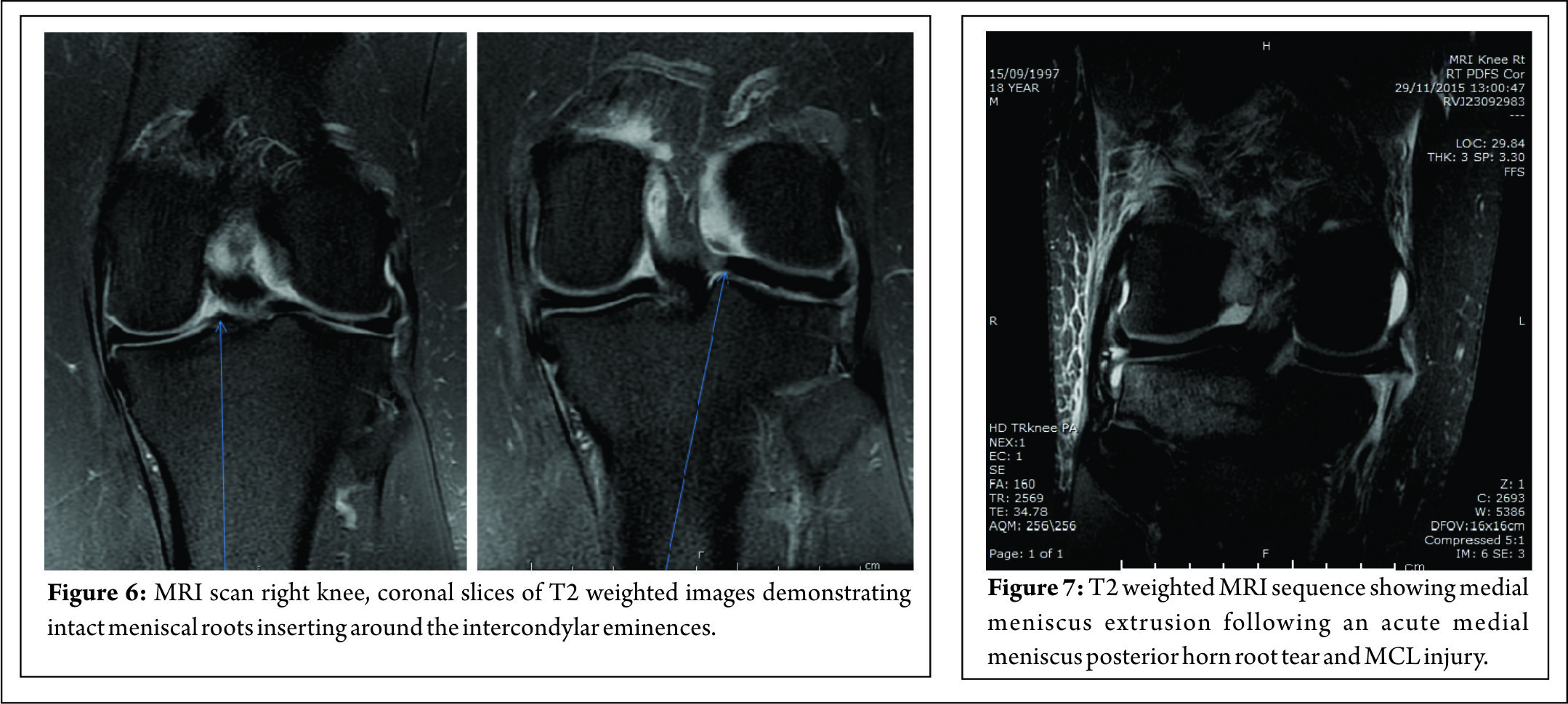 Meniscal Root Tears: Current Concepts | Asian Journal Of Arthroscopy